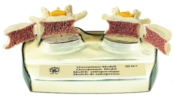 QS 66/4 Osteoporose-Modell